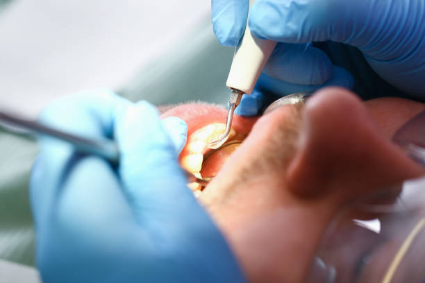 Best Emergency Wisdom Tooth Extraction in Richmond, MI