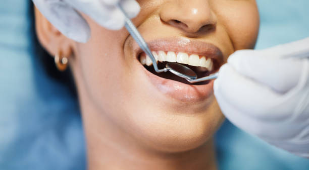 Best Knocked-Out Tooth (Avulsed Tooth) Treatment in Richmond, MI